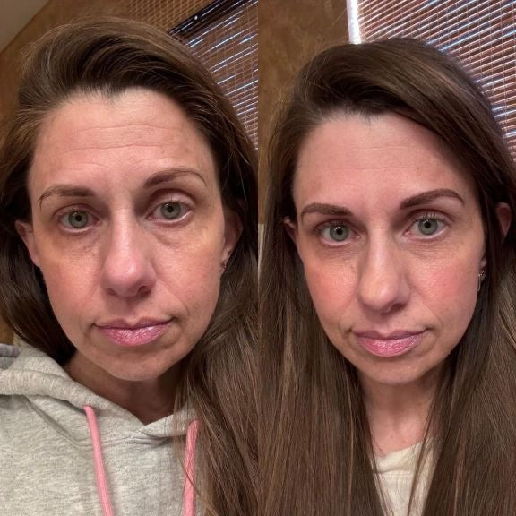 NORDERMA Anti-rynke plaster