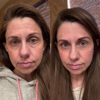 NORDERMA Anti-rynke plaster